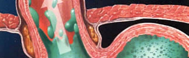 la-malattia-da-reflusso-gastroesofageo