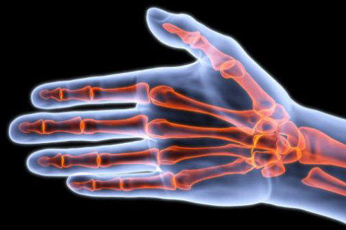 artrite psoriasica